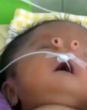 Baby Angelito was born with two tubes for a nose. Image of Baby Angelito was born with two tubes for a nose.