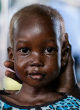 Four-year-old Nyajime Guet suffered severe acute malnutrition and weighed less than 20 pounds when she was taken to a UNICEF-backed clinic for help (UNICEF/UNI201744/Rich). Image of Four-year-old Nyajime Guet suffered severe acute malnutrition and weighed less than 20 pounds when she was taken to a UNICEF-backed clinic for help (UNICEF/UNI201744/Rich).