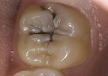 Fillings and root canals may become outdated dental practices (dentalpro). Image of Fillings and root canals may become outdated dental practices (dentalpro).