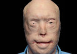 Patrick Harden before his face transplant. Image of Patrick Harden before his face transplant.