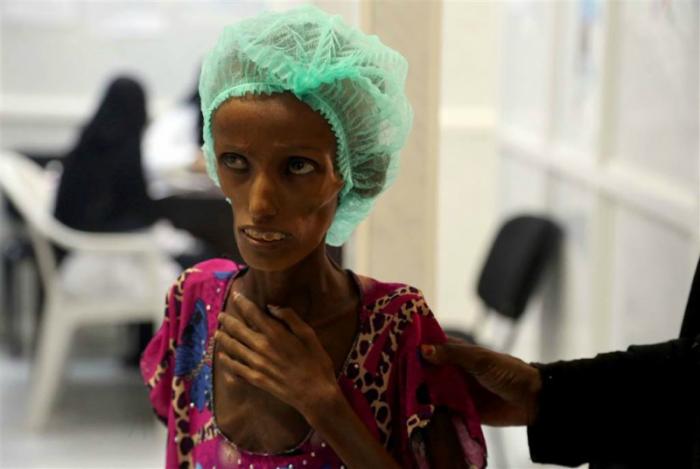 Victims of malnutrition are in desperate need. Victims of malnutrition are in desperate need.
