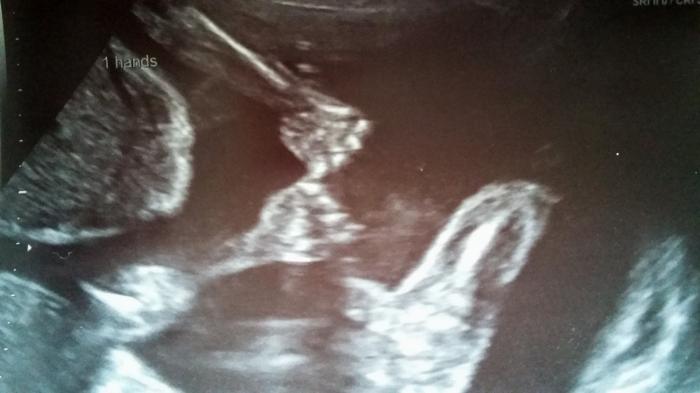 Twin ultrasound