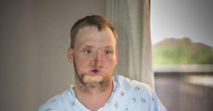 Andy Sandness, 31, receives face transplant 