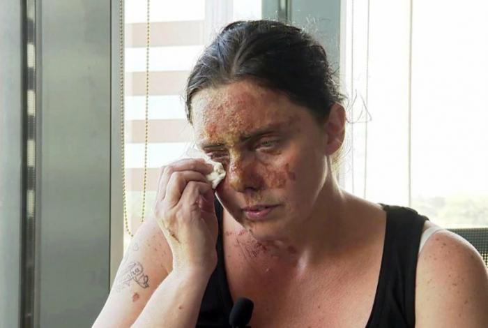 Victims of acid attacks are often left with more than just physical scarring. Victims of acid attacks are often left with more than just physical scarring.