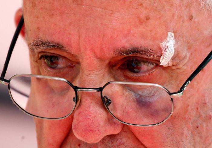 Pope Francis with a black eye 