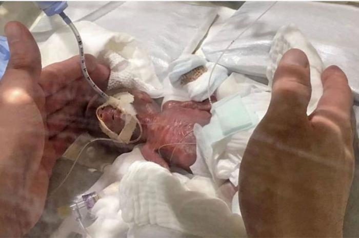 Smallest baby born Smallest baby born