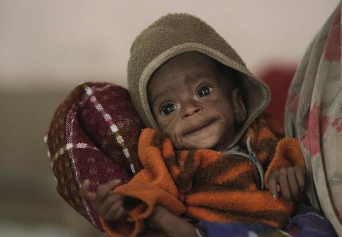 When you donate via Your Catholic Voice Foundation, you fight crippling hunger like this, directly. When you donate via Your Catholic Voice Foundation, you fight crippling hunger like this, directly.