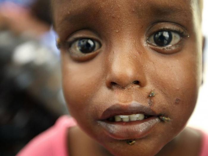 A child suffering from malnutrition and diarrhoea is seen at the Banadir hospital in the Somalian ca A child suffering from malnutrition and diarrhoea is seen at the Banadir hospital in the Somalian ca
