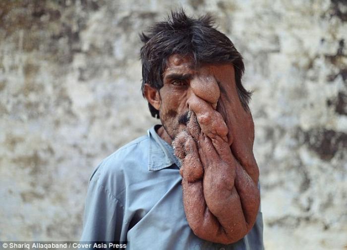 Chana Lal, 35, who lives in a remote village just outside Lucknow, in Uttar Pradesh, India, can Chana Lal, 35, who lives in a remote village just outside Lucknow, in Uttar Pradesh, India, can