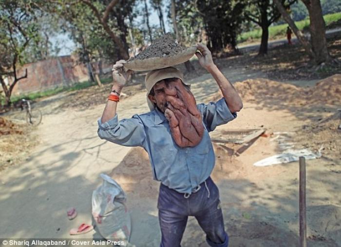 Although he picks up work when he can, Lal says it is painful to work with the tumor. Although he picks up work when he can, Lal says it is painful to work with the tumor.