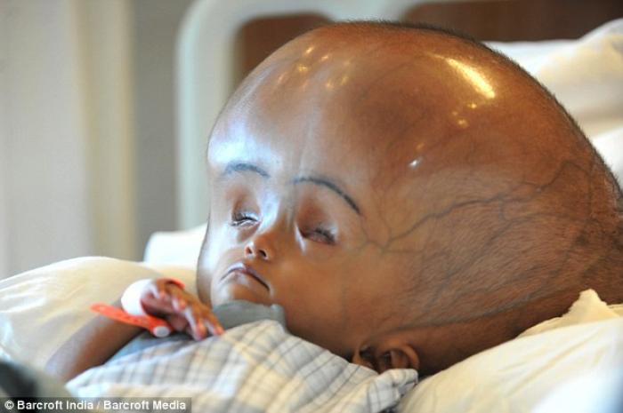 Three-year-old Roona Begum was rushed to hospital in New Delhi, India, last year, suffering an extre Three-year-old Roona Begum was rushed to hospital in New Delhi, India, last year, suffering an extre