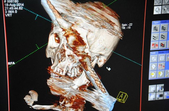 X-rays taken before surgery showed how the solid metal bar, which was at least an inch thick, passed X-rays taken before surgery showed how the solid metal bar, which was at least an inch thick, passed